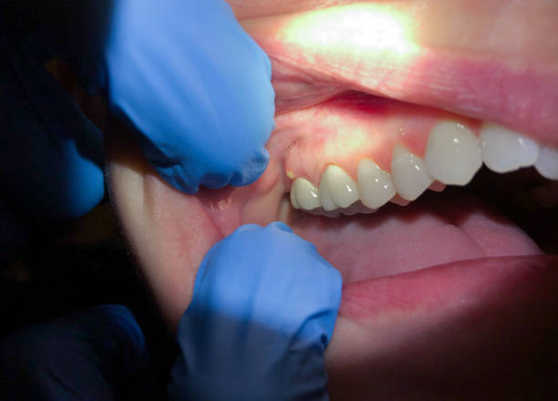 Best Emergency Treatment for Dental Infections or Abscesses in Waynesboro, GA